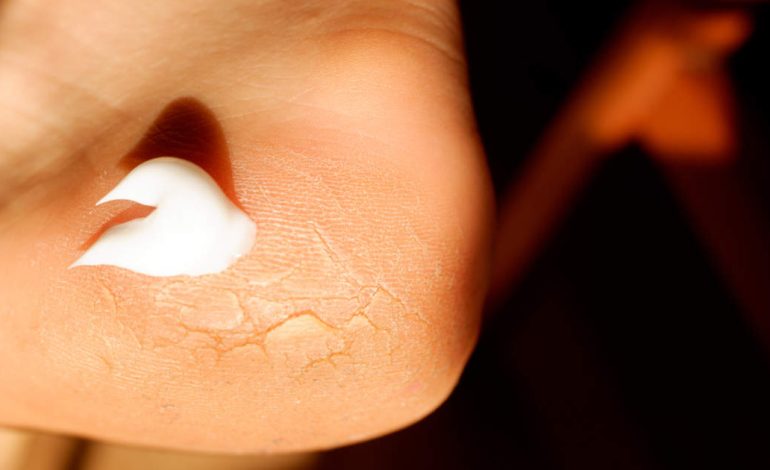 La crème à l'urée est bénéfique pour la peau sèche, craquelée et plus encore