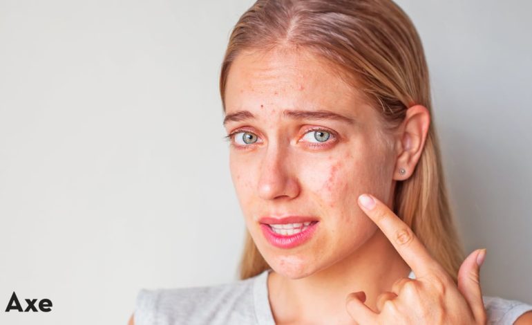 Comment se débarrasser de l'acné nodulaire