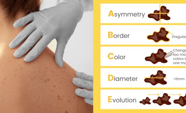 Symptômes du cancer de la peau + thérapies naturelles et prévention