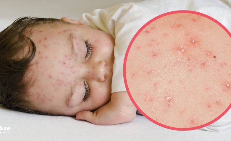 Symptômes de la varicelle + 4 façons naturelles de trouver un soulagement
