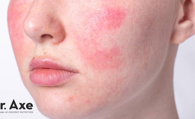Traitement de la rosacée: 6 façons naturelles de traiter votre peau