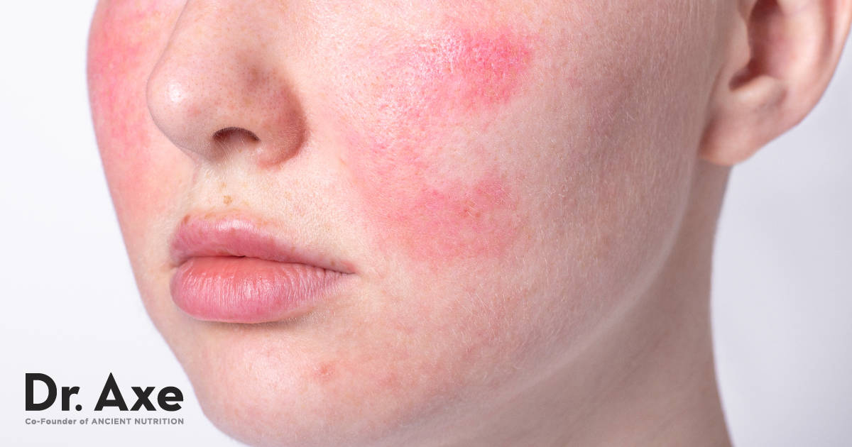 Traitement de la rosacée: 6 façons naturelles de traiter votre peau