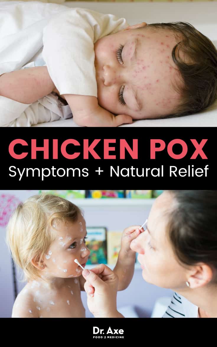 Symptômes de la varicelle - Dr Axe